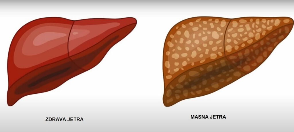 kako ocistiti jetru - Vaš Doktor 2